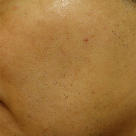 IPL光治療 施術12日後