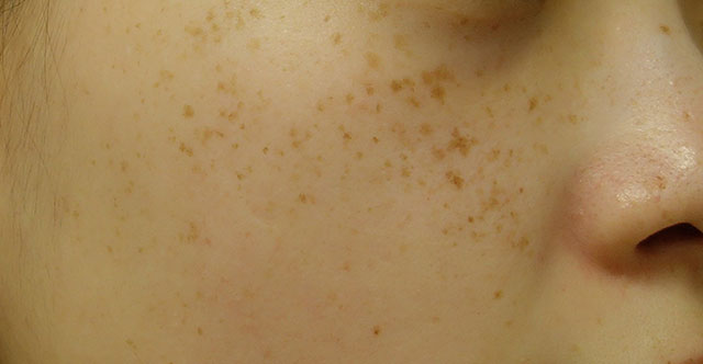 IPL光治療 施術前