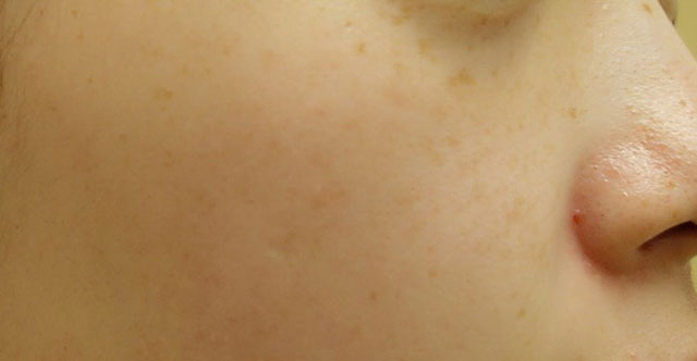 IPL光治療 施術後