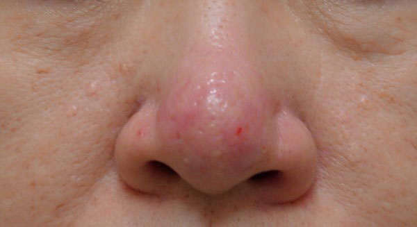 IPL光治療 施術前