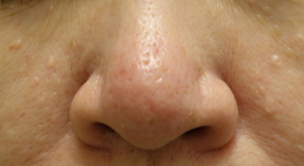 IPL光治療 施術後