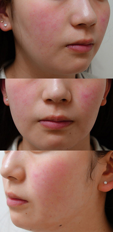 IPL光治療 施術前