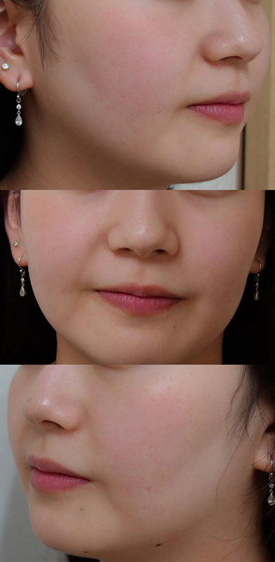 IPL光治療 施術後