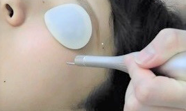 炭酸ガスレーザー