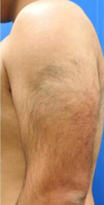 医療脱毛（男性）施術前