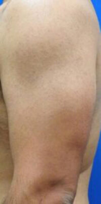 医療脱毛（男性）施術後