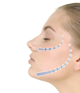 HIFU（リフテラV）によるリフトアップイメージ