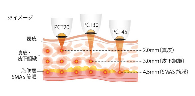 HIFU（リフテラV）照射イメージ