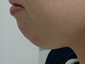 ヒアルロン酸 顎施術前