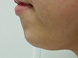 ヒアルロン酸 顎施術後