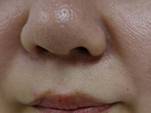 ヒアルロン酸 左法令線施術 施術前