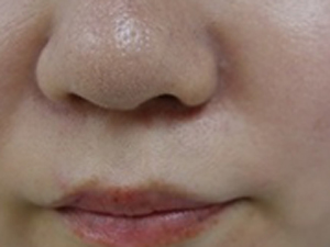 ヒアルロン酸 左法令線施術 施術後