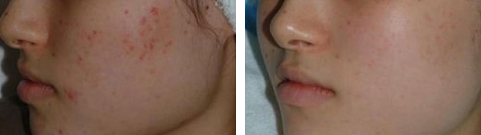 IPL光治療 施術前後の写真①