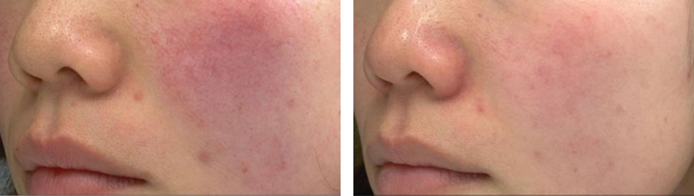 IPL光治療 施術前後の写真③