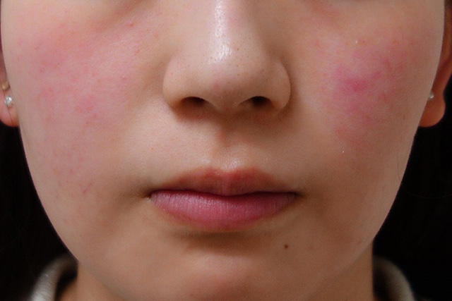 あから顔のIPL光治療前