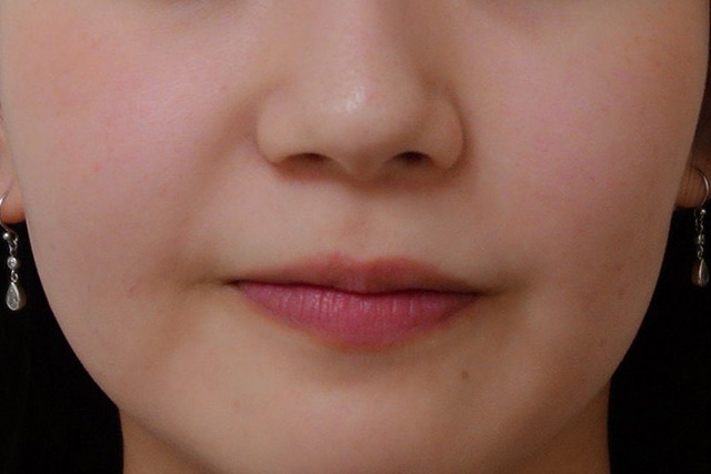 あから顔のIPL光治療後