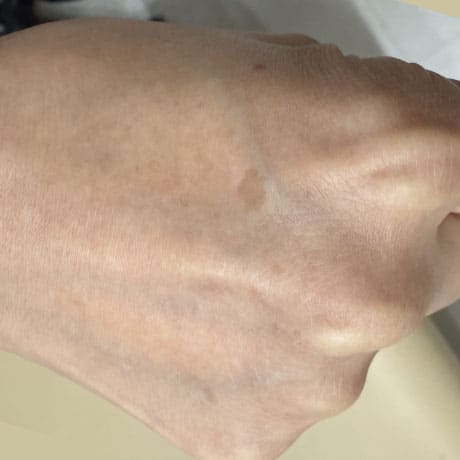 Qスイッチレーザー 照射前