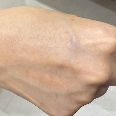 Qスイッチレーザー 照射後2週間